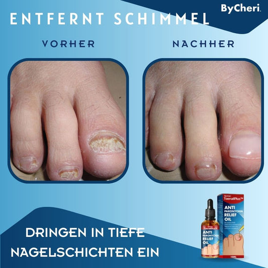 Frendorf | 1+1 GRATIS TEMPORÄR | ToePerfect - Heilt Zehen- und Handnägel