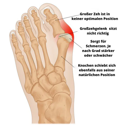 Frendorf | Ballenzehkorrektor - Rette deinen Zeh bevor es zu spät ist!