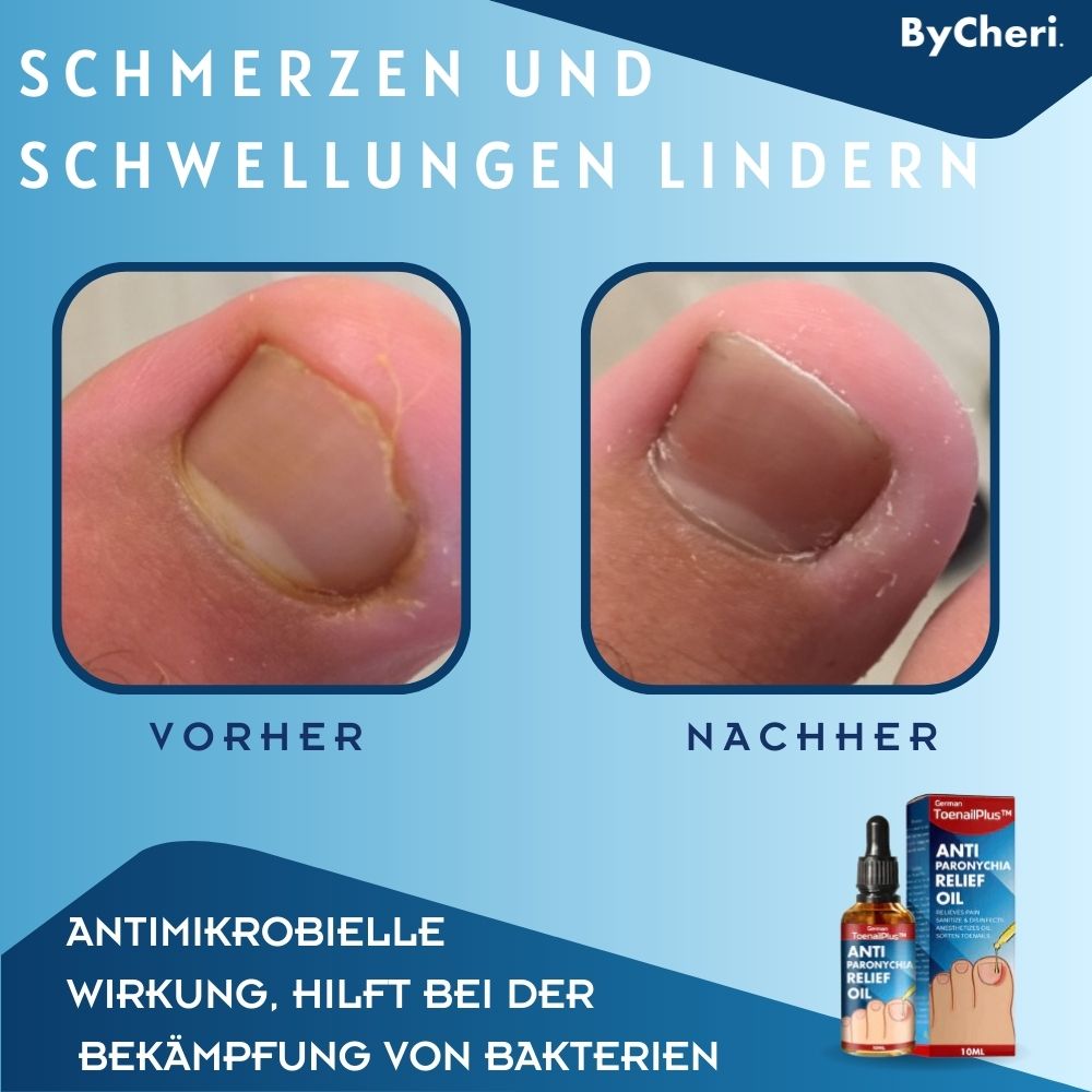 Frendorf | 1+1 GRATIS TEMPORÄR | ToePerfect - Heilt Zehen- und Handnägel