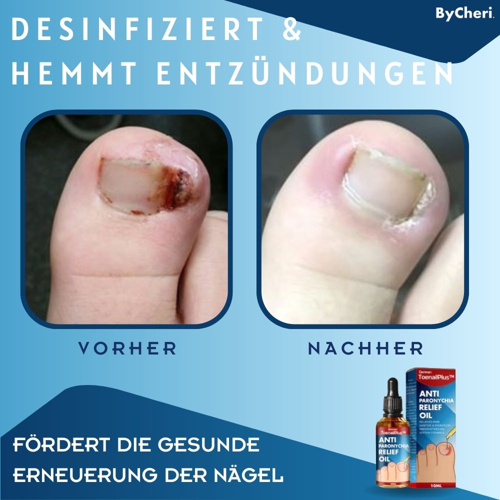 Frendorf | 1+1 GRATIS TEMPORÄR | ToePerfect - Heilt Zehen- und Handnägel
