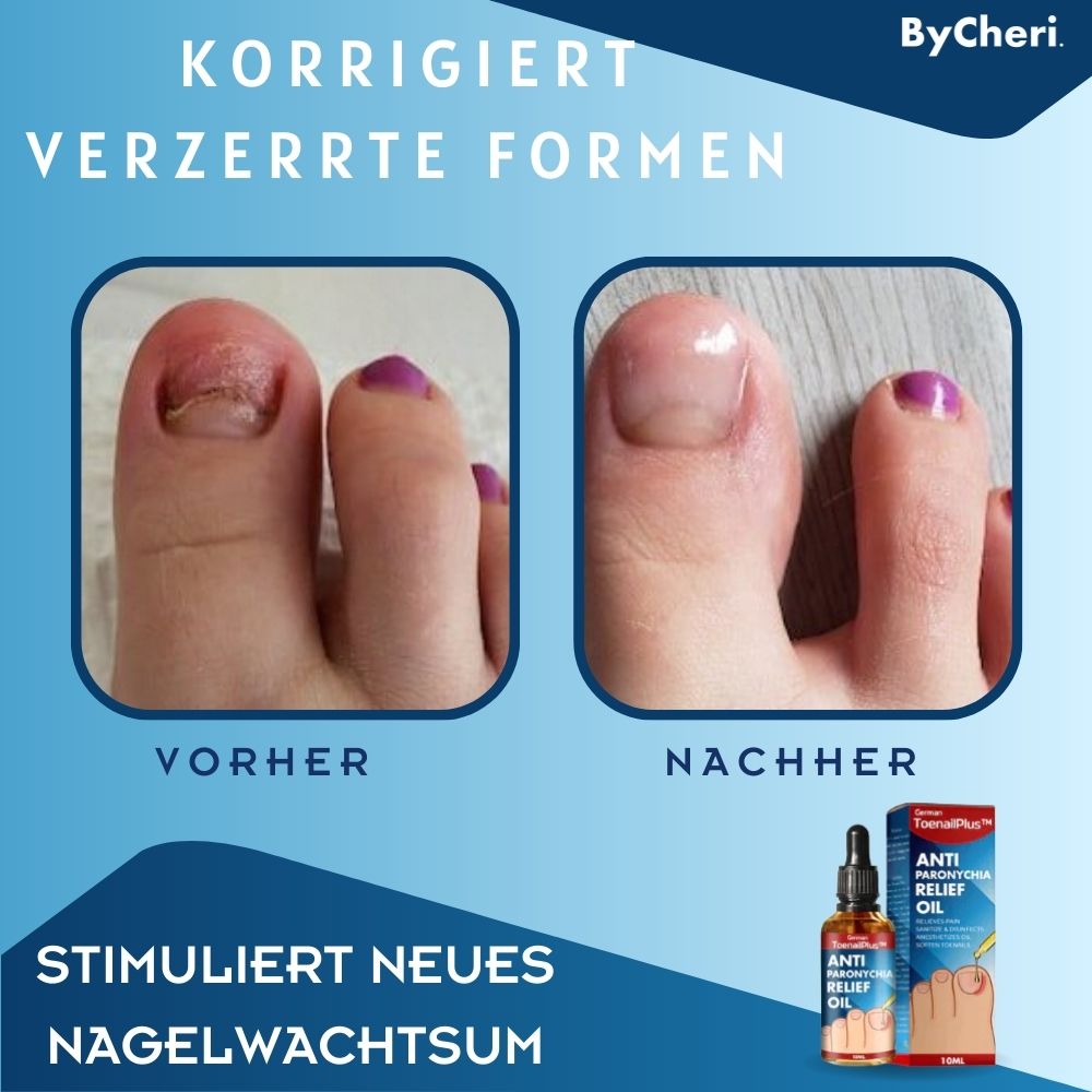 Frendorf | 1+1 GRATIS TEMPORÄR | ToePerfect - Heilt Zehen- und Handnägel