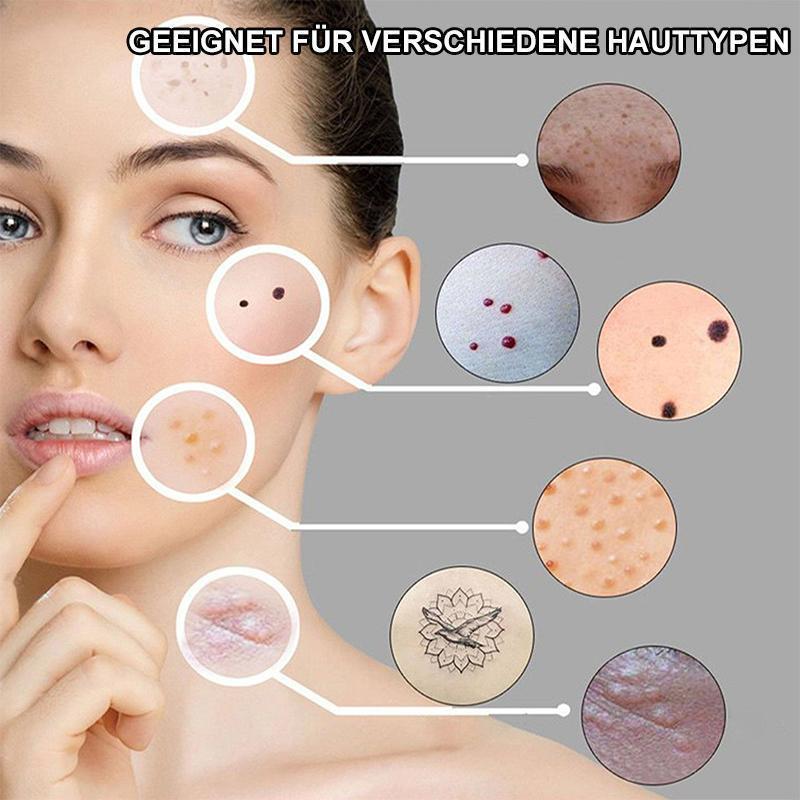 Frendorf | Laserbehandlung-Stift  Blu-Ray unerwünschte Akne entfernen