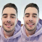 Frendorf | On Smile Veneers (Ober- und Unterkiefer inbegriffen)