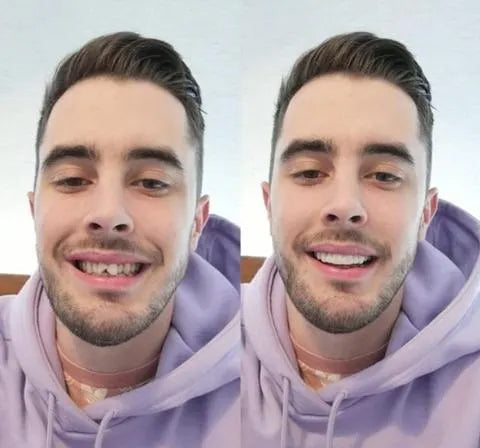 Frendorf | On Smile Veneers (Ober- und Unterkiefer inbegriffen)