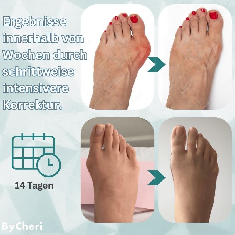 Frendorf | 1+1 GRATIS TEMPORÄR | OrthoAlign – Großzehenkorrektor