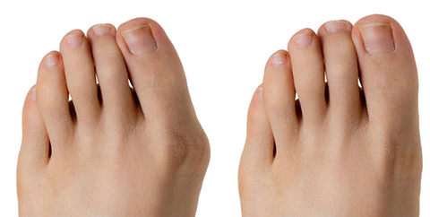 Frendorf | Ballenzehkorrektor - Rette deinen Zeh bevor es zu spät ist!