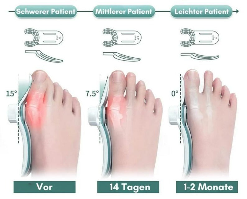 Frendorf | 1+1 GRATIS TEMPORÄR | OrthoAlign – Großzehenkorrektor