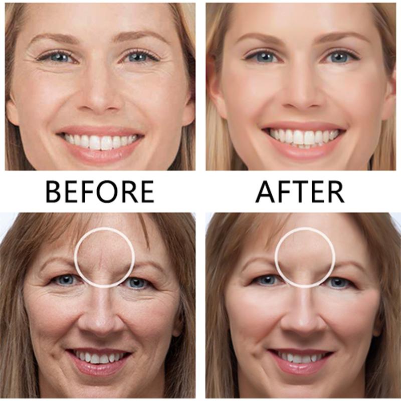 Frendorf | Face Nutrition Faltenentfernung Lift Aufkleber