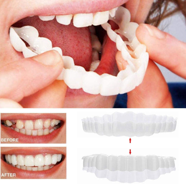 Frendorf | On Smile Veneers (Ober- und Unterkiefer inbegriffen)