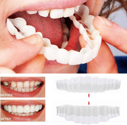 Frendorf | On Smile Veneers (Ober- und Unterkiefer inbegriffen)