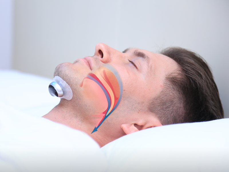 Frendorf | SilentDream - Fortschrittliches Anti-Schnarch Puls-Gerät - Effektive Schnarchlösung
