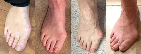 Frendorf | Ballenzehkorrektor - Rette deinen Zeh bevor es zu spät ist!