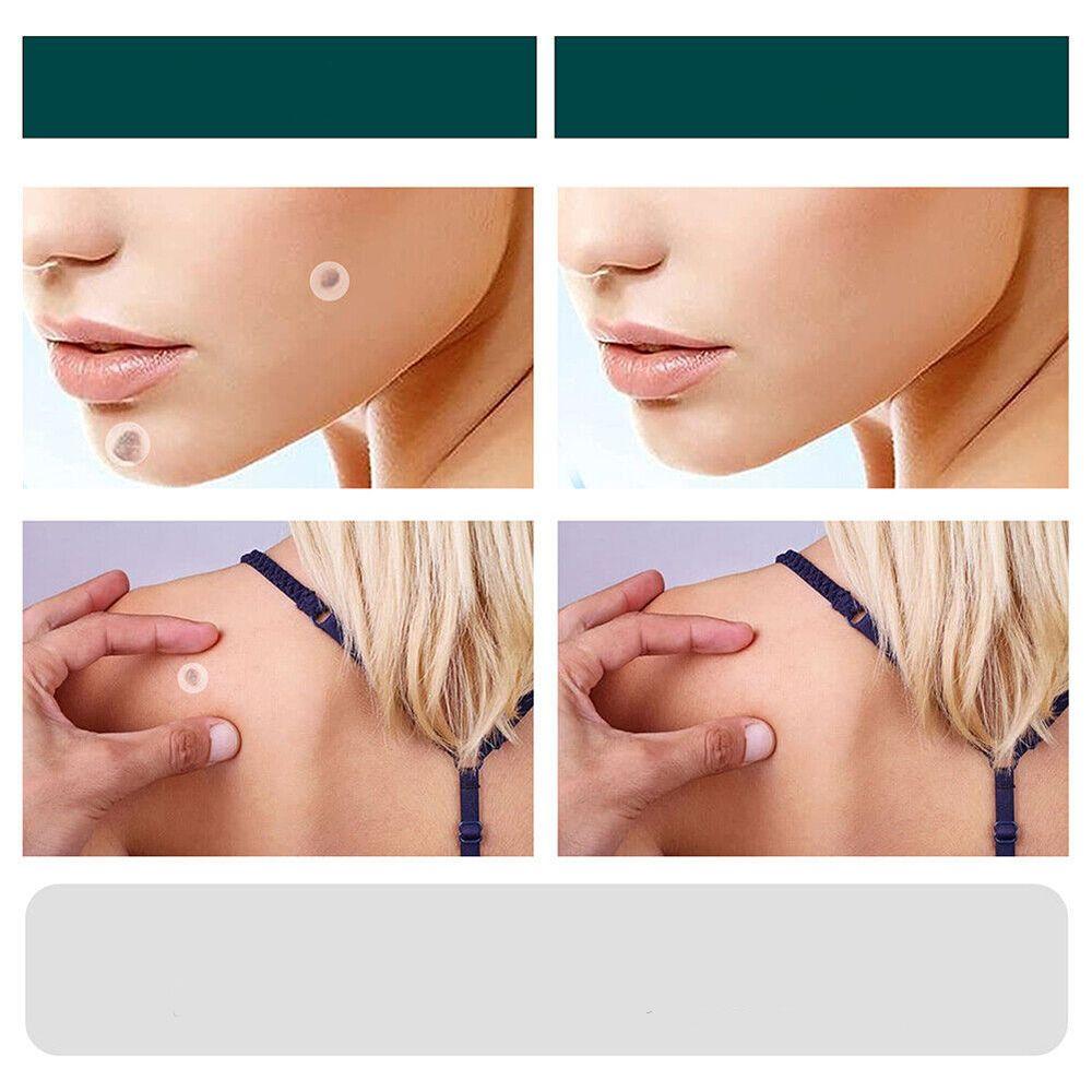 Frendorf | SkinClear - Pflaster zur Entfernung von Flecken und Warzen