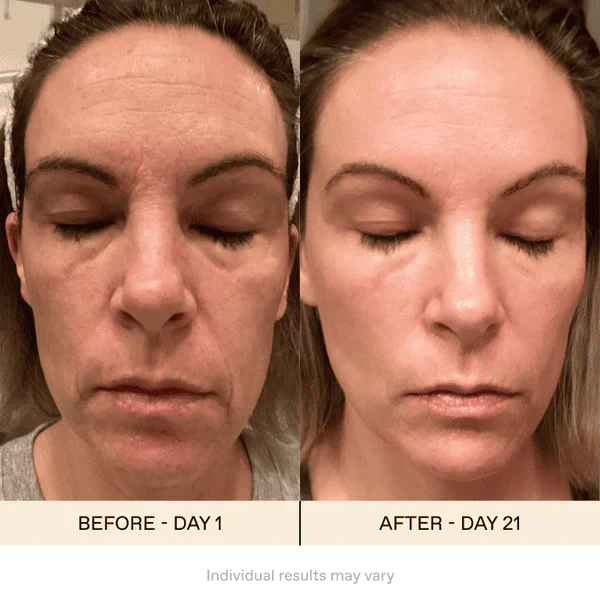 Frendorf | AugeVerjüngen Magie der Augenwiederherstellung in nur wenigen Wochen