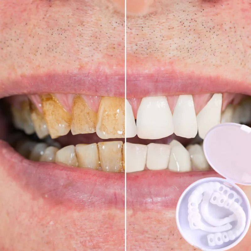 Frendorf | SmileSnap - Immer das perfekte Lächeln mit diesen Veneers