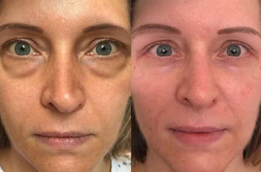 Frendorf | AugenGlows®