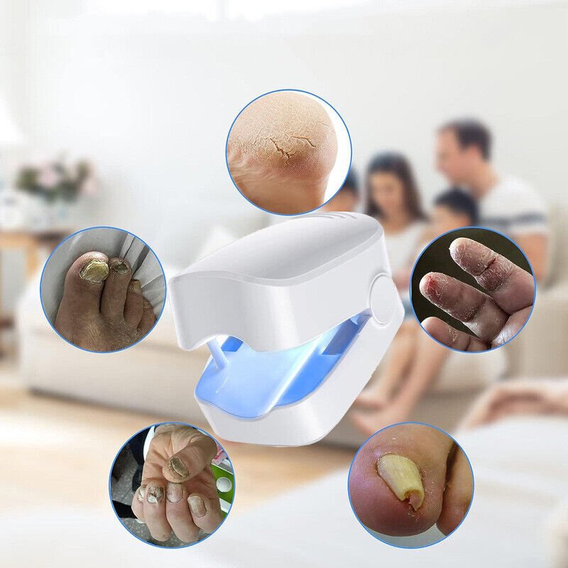 Frendorf | Lasergerät zur Nagelpilz-Reinigung – Revolutionäres, hocheffizientes Lichttherapiegerät von Expert für Erkrankungen der Zehennägel