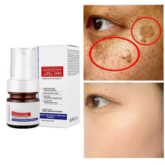 Frendorf | SpotLuxe – Serum zur Entfernung von Dunklen Flecken