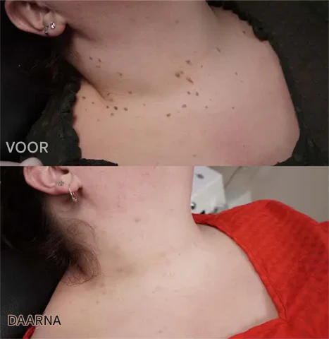 Frendorf | BeeNaturale– Entfernt Hautflapjes und Flecken sanft und effektiv